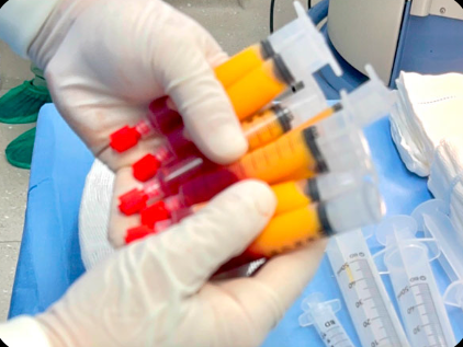Seringas com o tecido adiposo processado